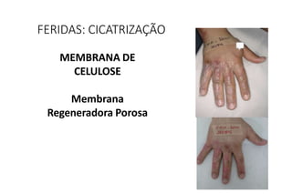 MEMBRANA DE
CELULOSE
Membrana
Regeneradora Porosa
FERIDAS: CICATRIZAÇÃO
 