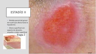 ESTADÍO II
• Pérdida parcial del grosor
de la piel que afecta hasta la
hipodermis
• Úlcera superficial con
aspecto de abrasión,
ampolla o cráter superficial
Cristell
 