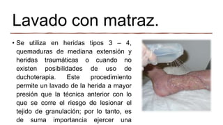 Lavado con matraz.
• Se utiliza en heridas tipos 3 – 4,
quemaduras de mediana extensión y
heridas traumáticas o cuando no
existen posibilidades de uso de
duchoterapia. Este procedimiento
permite un lavado de la herida a mayor
presión que la técnica anterior con lo
que se corre el riesgo de lesionar el
tejido de granulación; por lo tanto, es
de suma importancia ejercer una
 