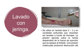 Lavado
con
jeringa. • Se utiliza en heridas tipos 2 – 3 y en
cavidades profundas que necesitan
ser lavadas a través de drenajes. La
presión ejercida sobre la herida
despenderá de la fuerza de eyección
que se aplique al émbolo. Una presión
inadecuada producirá destrucción del
 