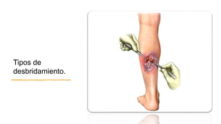 Tipos de
desbridamiento.
 