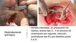 Desbridamiento
quirúrgico.
• Heridas infectadas, en preparación de
injertos, úlceras tipo 3 – 4 en proceso de
cicatrización por segunda. Intención,
quemaduras tipo B y pie diabético grado
II a IV.
 