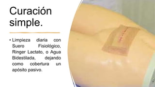 Curación
simple.
• Limpieza diaria con
Suero Fisiológico,
Ringer Lactato, o Agua
Bidestilada, dejando
como cobertura un
apósito pasivo.
 