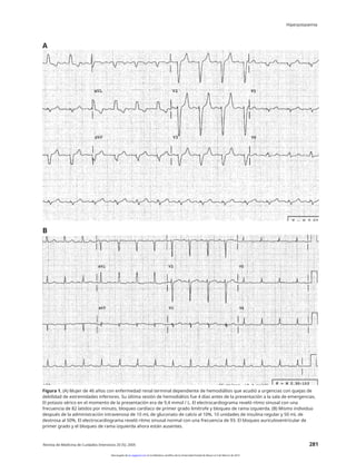 Hiperpotasemia
A
B
Figura 1. (A) Mujer de 46 años con enfermedad renal terminal dependiente de hemodiálisis que acudió a urgencias con quejas de
debilidad de extremidades inferiores. Su última sesión de hemodiálisis fue 4 días antes de la presentación a la sala de emergencias.
El potasio sérico en el momento de la presentación era de 9,4 mmol / L. El electrocardiograma reveló ritmo sinusal con una
frecuencia de 82 latidos por minuto, bloqueo cardíaco de primer grado limítrofe y bloqueo de rama izquierda. (B) Mismo individuo
después de la administración intravenosa de 10 mL de gluconato de calcio al 10%, 10 unidades de insulina regular y 50 mL de
dextrosa al 50%. El electrocardiograma reveló ritmo sinusal normal con una frecuencia de 93. El bloqueo auriculoventricular de
primer grado y el bloqueo de rama izquierda ahora están ausentes.
Revista de Medicina de Cuidados Intensivos 20 (5); 2005 281
Descargado de jic.sagepub.com en la biblioteca científica de la Universidad Estatal de Moscú el 3 de febrero de 2014
 