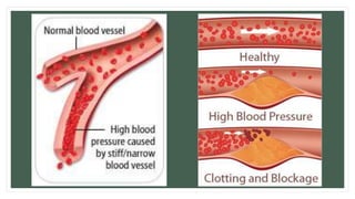 Manejo De Hipertension