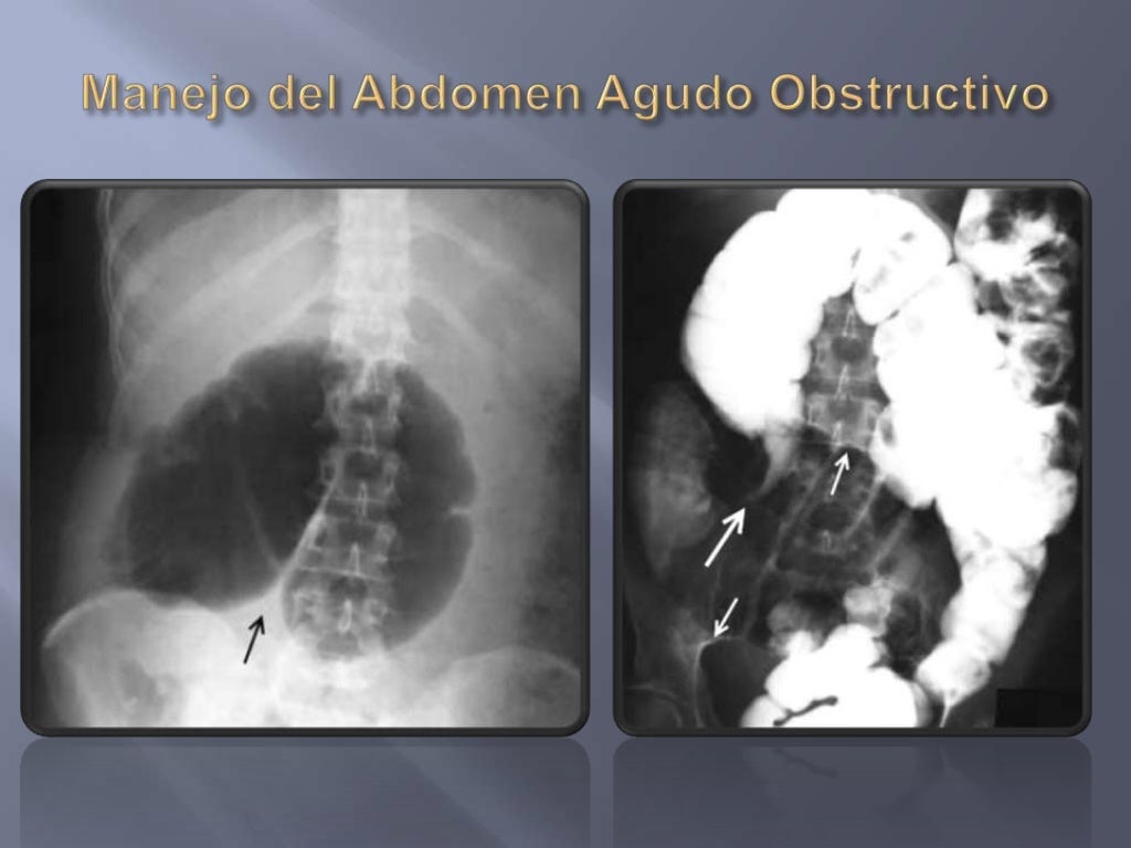 Abdomen Agudo Obstructivo