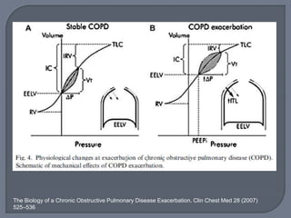 The Biology of a Chronic Obstructive Pulmonary Disease Exacerbation. Clin Chest Med 28 (2007)
525–536
 