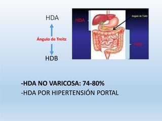 HDA
HDB
-HDA NO VARICOSA: 74-80%
-HDA POR HIPERTENSIÓN PORTAL
Ángulo de Treitz
 