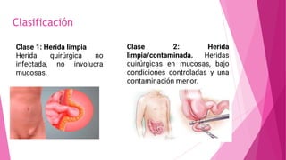 Clasificación
Clase 1: Herida limpia
Herida quirúrgica no
infectada, no involucra
mucosas.
Clase 2: Herida
limpia/contaminada. Heridas
quirúrgicas en mucosas, bajo
condiciones controladas y una
contaminación menor.
 