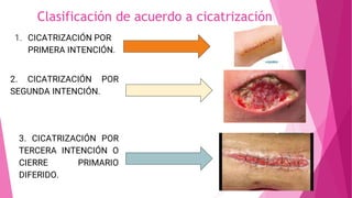Clasificación de acuerdo a cicatrización
1. CICATRIZACIÓN POR
PRIMERA INTENCIÓN.
2. CICATRIZACIÓN POR
SEGUNDA INTENCIÓN.
3. CICATRIZACIÓN POR
TERCERA INTENCIÓN O
CIERRE PRIMARIO
DIFERIDO.
 