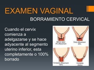 EXAMEN VAGINAL
Cuando el cervix
comienza a
adelgazarse y se hace
adyacente al segmento
uterino inferior, esta
completament...