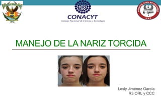 MANEJO DE LA NARIZ TORCIDA
Lesly Jiménez García
R3 ORL y CCC
 