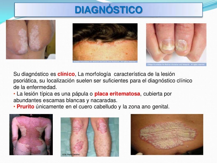 Atopichesky la dermatitis el régimen para los menúes adultos
