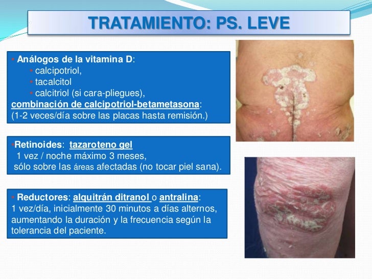 psoriasis psoriasis