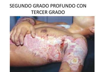 SEGUNDO GRADO PROFUNDO CON
TERCER GRADO
 