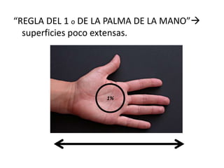 “REGLA DEL 1 o DE LA PALMA DE LA MANO”
superficies poco extensas.
1%
 