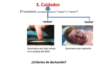 3. Cuidados
“MENOR”
1º VALORAMOS. ¿La quemadura es “ mayor” o “ menor”?
“MAYOR”
Quemadura por explosiónQuemadura por bajo voltaje
en el pulpejo del dedo.
¿Criterios de derivación?
 