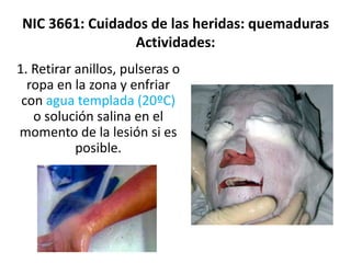 NIC 3661: Cuidados de las heridas: quemaduras
Actividades:
1. Retirar anillos, pulseras o
ropa en la zona y enfriar
con agua templada (20ºC)
o solución salina en el
momento de la lesión si es
posible.
 