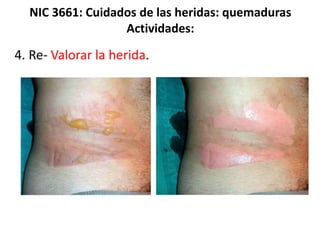 NIC 3661: Cuidados de las heridas: quemaduras
Actividades:
4. Re- Valorar la herida.
 