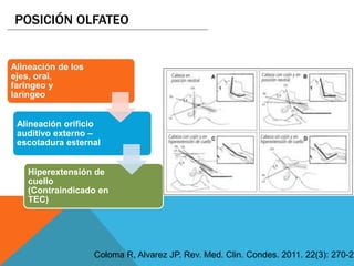 Alineación de los
ejes, oral,
faríngeo y
laríngeo
Alineación orificio
auditivo externo –
escotadura esternal
Hiperextensión de
cuello
(Contraindicado en
TEC)
POSICIÓN OLFATEO
Coloma R, Alvarez JP. Rev. Med. Clin. Condes. 2011. 22(3): 270-27
 