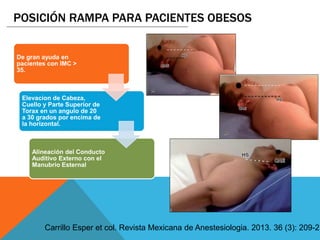 POSICIÓN RAMPA PARA PACIENTES OBESOS
De gran ayuda en
pacientes con IMC >
35.
Elevacion de Cabeza,
Cuello y Parte Superior de
Torax en un angulo de 20
a 30 grados por encima de
la horizontal.
Alineación del Conducto
Auditivo Externo con el
Manubrio Esternal
Carrillo Esper et col. Revista Mexicana de Anestesiologia. 2013. 36 (3): 209-21
 