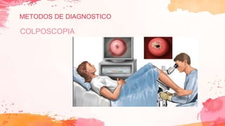 METODOS DE DIAGNOSTICO
COLPOSCOPIA
 