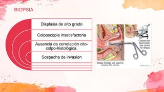 BIOPSIA
Displasia de alto grado
Colposcopia insatisfactoria
Ausencia de correlación cito-
colpo-histológica.
Sospecha de invasion
 