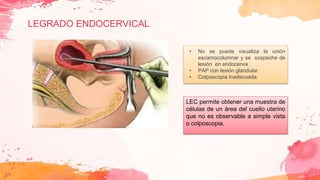 LEGRADO ENDOCERVICAL
• No se puede visualiza la unión
escamocolumnar y se sospeche de
lesión en endocérvix .
• PAP con lesión glandular.
• Colposcopia Inadecuada.
LEC permite obtener una muestra de
células de un área del cuello uterino
que no es observable a simple vista
o colposcopia.
 