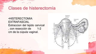 Clases de histerectomía
•HISTERECTOMIA
EXTRAFASCIAL
Extraccion del tejido cervical
, con resección de 1-2
cm de la cúpula vaginal.
 