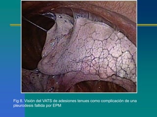Fig 8. Visión del VATS de adesiones tenues como complicación de una 
pleurodesis fallida por EPM 
 