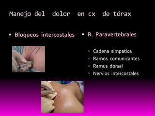 Bloqueos  intercostales B.  ParavertebralesCadena  simpaticaRamos  comunicantesRamus  dorsal Nervios  intercostalesManejo del  dolor  en cx  de tórax