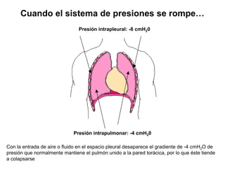 Cuando el sistema de presiones se rompe…
                               Presión intrapleural: -8 cmH20




                             Presión intrapulmonar: -4 cmH20

Con la entrada de aire o fluido en el espacio pleural desaparece el gradiente de -4 cmH2O de
presión que normalmente mantiene el pulmón unido a la pared torácica, por lo que éste tiende
a colapsarse
 