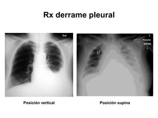 Rx derrame pleural




Posición vertical       Posición supina
 