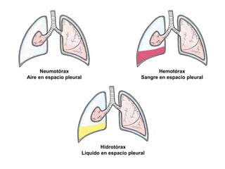 Neumotórax                                         Hemotórax
Aire en espacio pleural                           Sangre en espacio pleural




                                  Hidrotórax
                          Líquido en espacio pleural
 