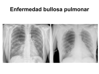 Enfermedad bullosa pulmonar
 