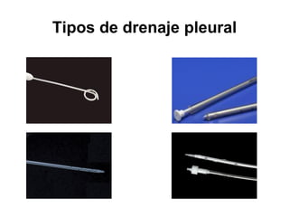 Tipos de drenaje pleural
 