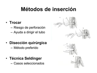 Métodos de inserción

• Trocar
  – Riesgo de perforación
  – Ayuda a dirigir el tubo


• Disección quirúrgica
  – Método preferido


• Técnica Seldinger
  – Casos seleccionados
 
