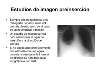 Estudios de imagen preinserción
• Siempre deberá realizarse una
  radiografía de tórax antes del
  drenaje pleural, salvo en el caso
  de un neumotórax a tensión
• Un estudio de imagen servirá
  para seleccionar el lugar de
  inserción y la dirección del
  drenaje
• Si no puede aspirarse libremente
  aire o líquido con una aguja
  durante la anestesia, la inserción
  del drenaje se hará bajo guía
  ecográfica o por TAC
 