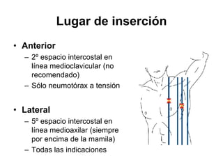 Lugar de inserción
• Anterior
  – 2º espacio intercostal en
    línea medioclavicular (no
    recomendado)
  – Sólo neumotórax a tensión


• Lateral
  – 5º espacio intercostal en
    línea medioaxilar (siempre
    por encima de la mamila)
  – Todas las indicaciones
 