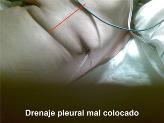 Drenaje pleural mal colocado
 