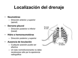 Localización del drenaje

• Neumotórax
   – Dirección anterior y superior
     (apical)
• Derrame pleural
   – Dirección posterior e inferior
     (basal)
• Hidro o hemoneumotórax
   – Dirección posterior y superior
• Ausencia de loculación
   – Cualquier posición puede ser
     efectiva
   – Un tubo normofuncionante no debe
     recolocarse sólo por la apariencia
     radiográfica
 
