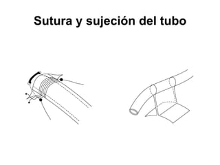 Sutura y sujeción del tubo
 