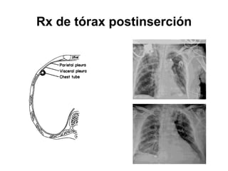 Rx de tórax postinserción
 