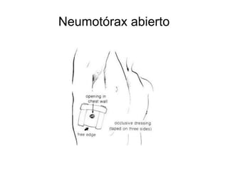 Neumotórax abierto
 