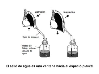 El sello de agua es una ventana hacia el espacio pleural
 