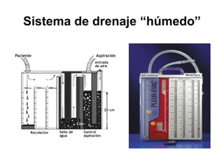 Sistema de drenaje “húmedo”
 