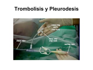 Trombolisis y Pleurodesis
 
