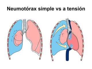 Neumotórax simple vs a tensión
 
