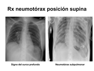 Rx neumotórax posición supina




 Signo del surco profundo   Neumotórax subpulmonar
 