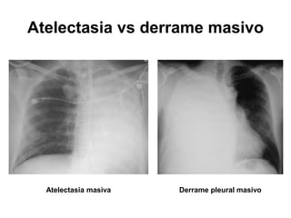 Atelectasia vs derrame masivo




  Atelectasia masiva   Derrame pleural masivo
 